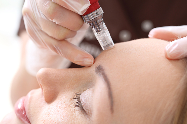 microneedling dermapen rotterdam